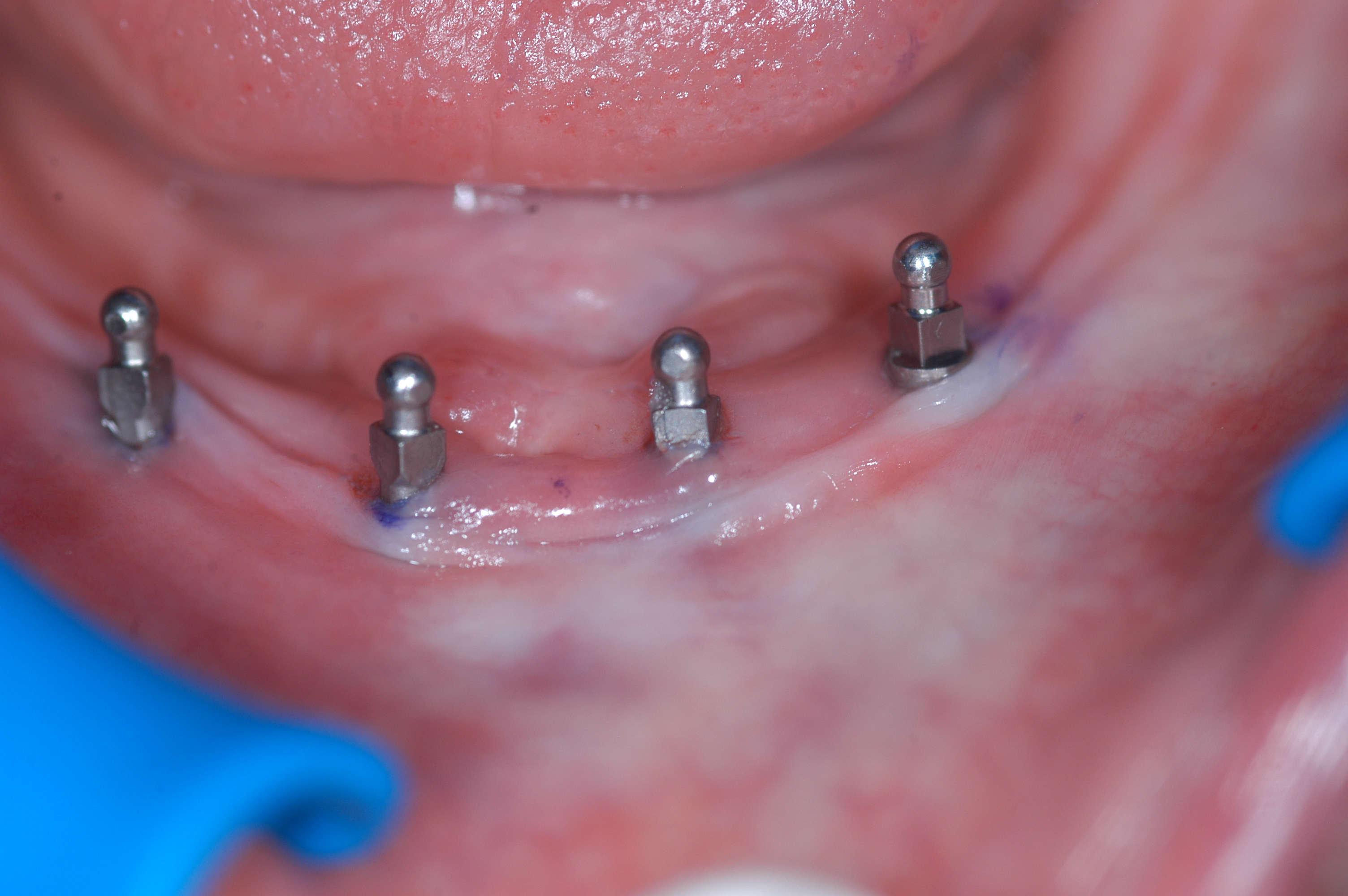 Day implants were placed on resorbed mandible
